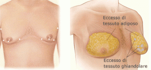 problemi di ginecomastia
