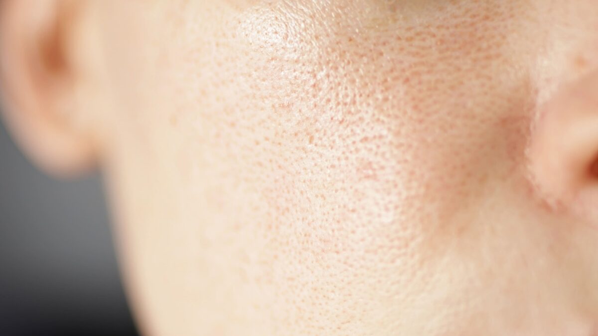 peeling chimico
